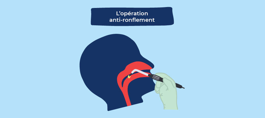 Opération anti-ronflement